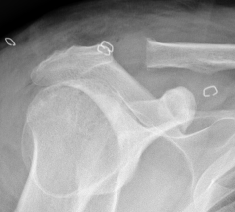 Traitement chirurgical de l’arthropathie acromio-claviculaire
